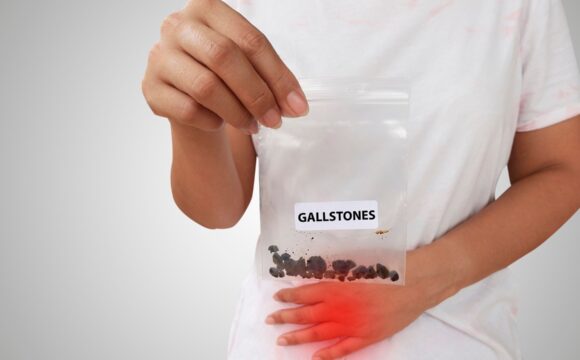 Gallstones: Symptoms, Diagnosis, and Treatment