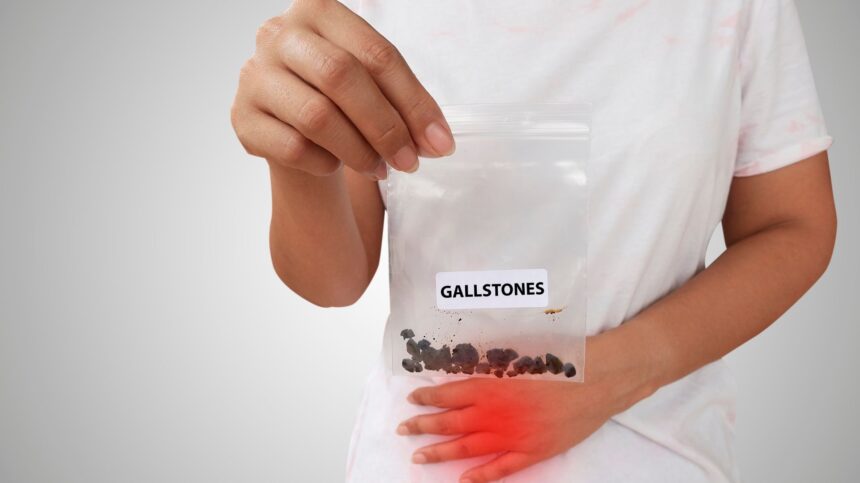 Gallstones: Symptoms, Diagnosis, and Treatment