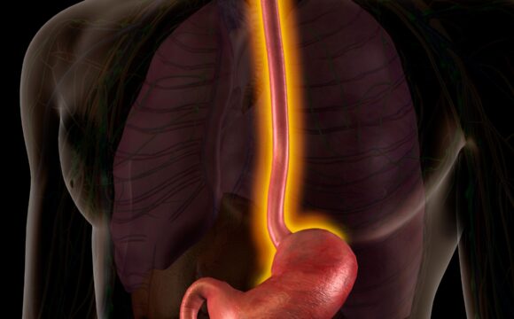 Barrett’s Esophagus: Symptoms, Causes, and Prevention