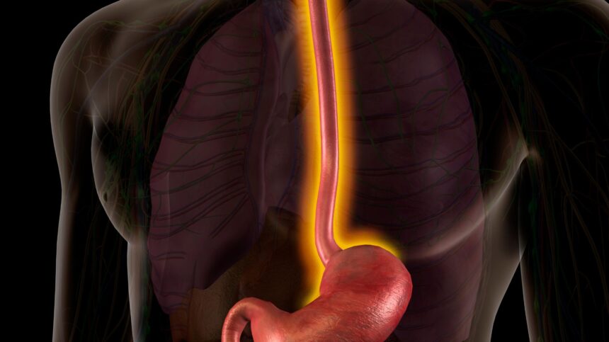 Barrett’s Esophagus: Symptoms, Causes, and Prevention